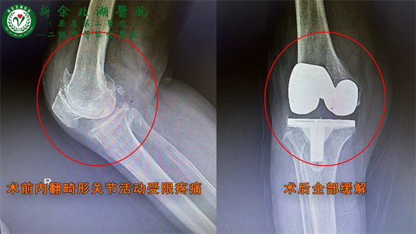 右膝人工膝关节置换术 —— 为七旬老太解除20年关节炎“重担”