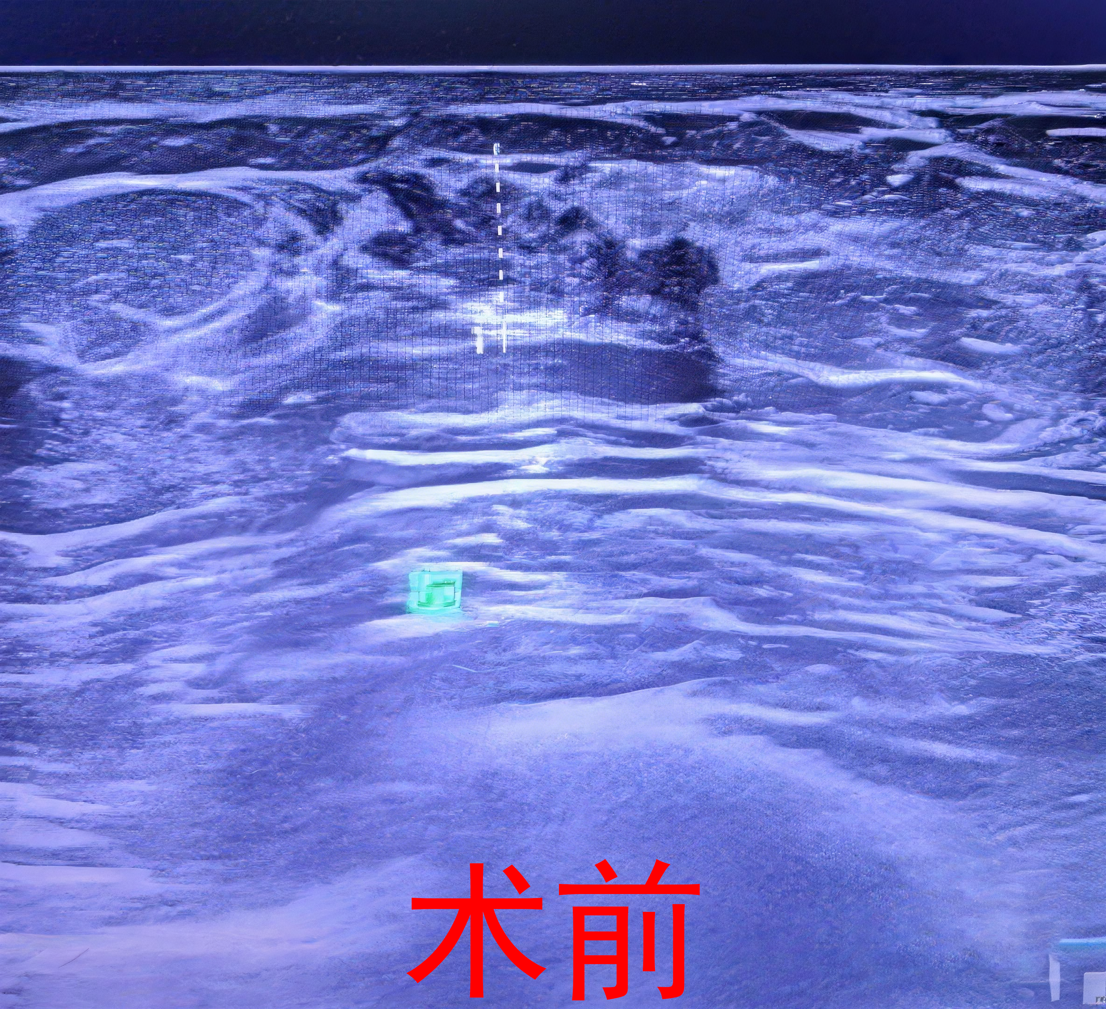 【手术纪实】18岁男生也有“乳腺烦恼”：双侧乳房发育的腔镜微创治疗