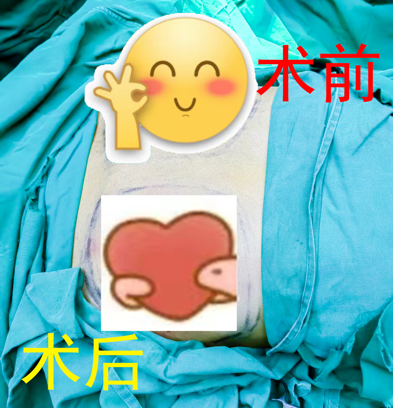 【手术纪实】18岁男生也有“乳腺烦恼”：双侧乳房发育的腔镜微创治疗