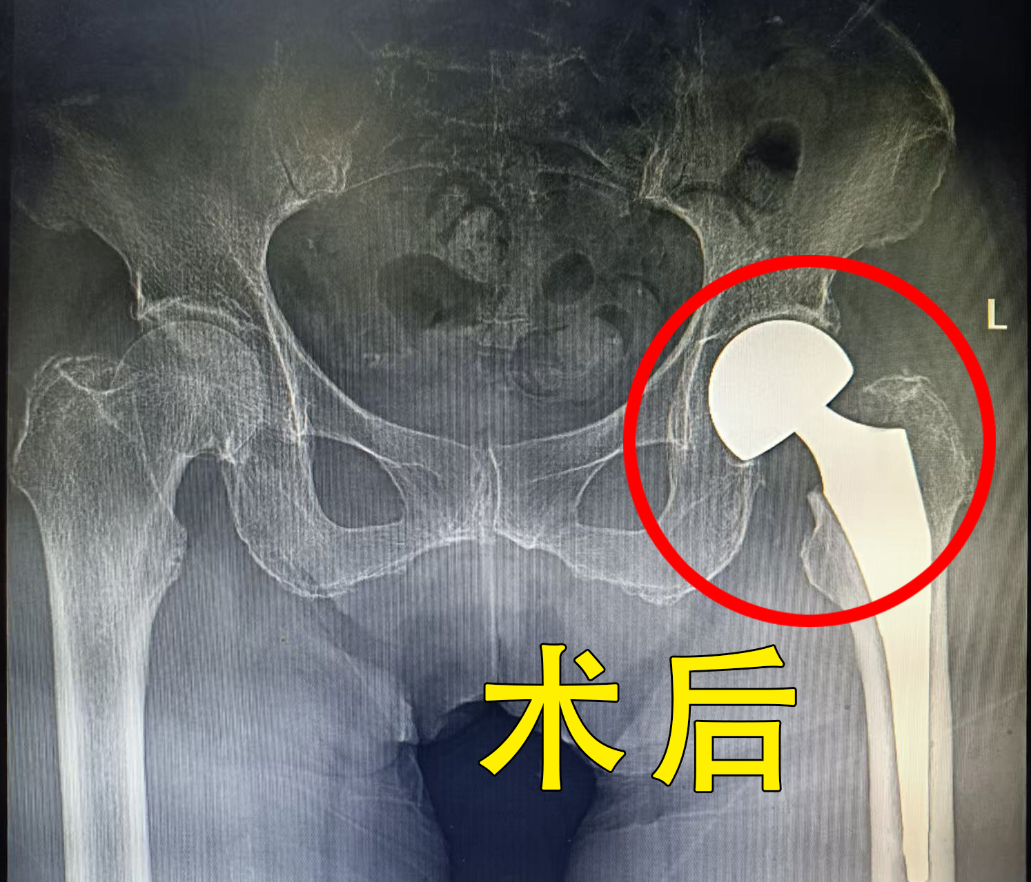 多科联动，我院成功为89岁高龄患者完成髋部骨折手术