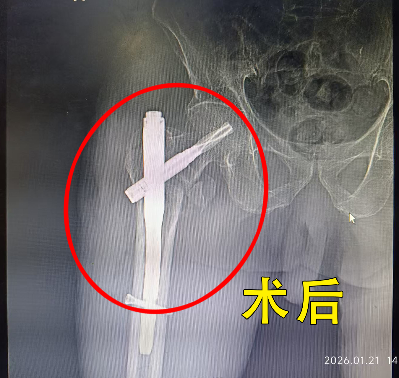 91岁老人髋部粉碎性骨折，我院多科协作成功实施手术