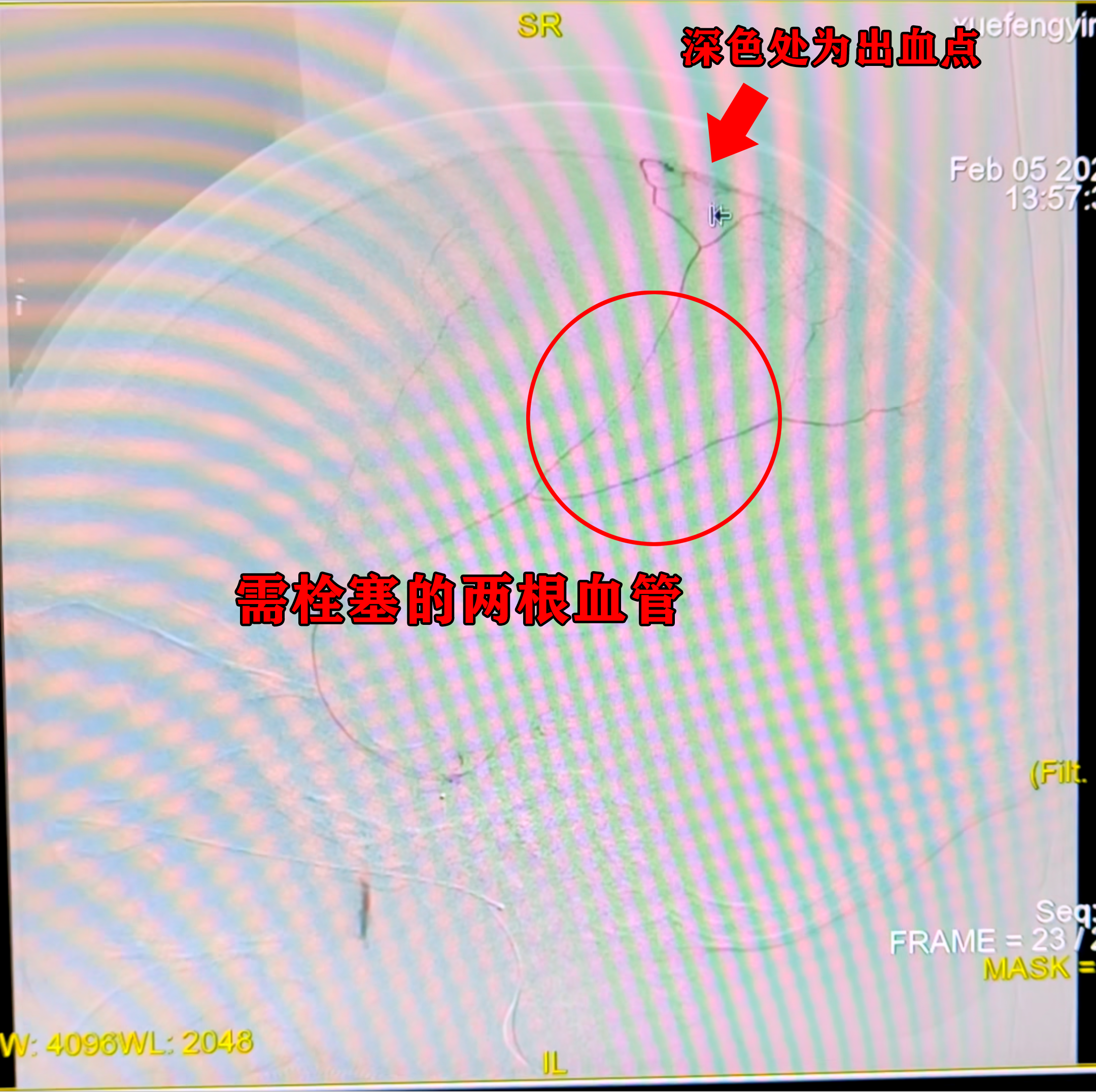 【仁术纪实】我院应用介入栓塞术治疗高龄创伤性硬膜下出血患者