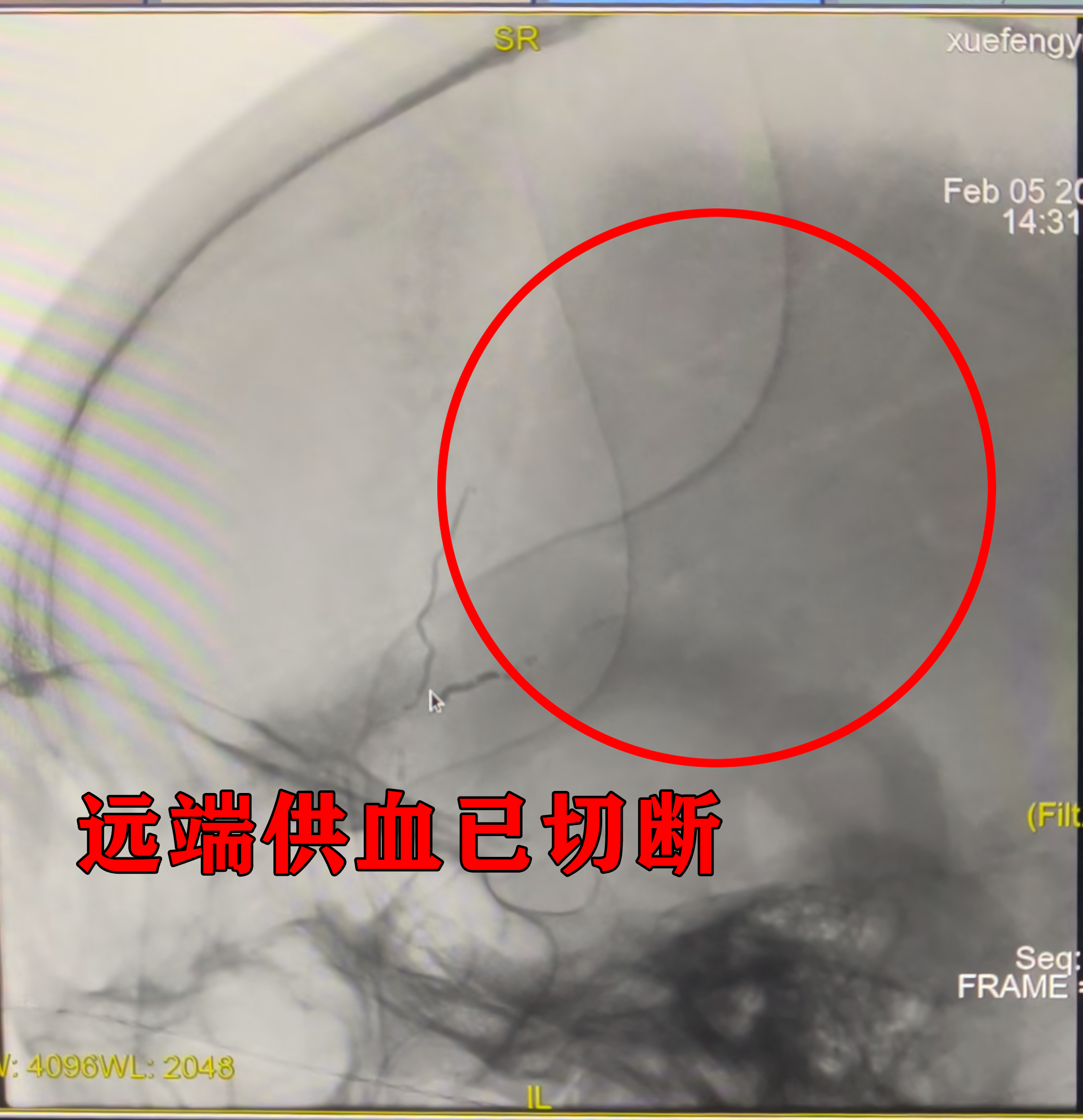 【仁术纪实】我院应用介入栓塞术治疗高龄创伤性硬膜下出血患者